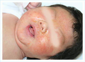 湿疹 赤ちゃんのお肌レスキュー おむつかぶれ あせものための市販薬 ポリベビー 佐藤製薬